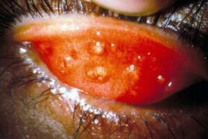 m1550069-stage-2-trachoma-science-photo-library-high_fr-300x201-2277301
