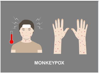 Que peut-on savoir de la variole de singe ou Monkeypox ?